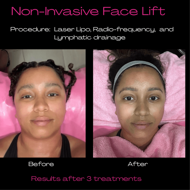 5 - Face Tightening & Contouring at To Cut & Dye For | Sculpted with Kare in Los Angeles, CA